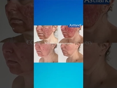 HIFU vs. Laser de CO2 Fracionário, qual é que preferes?
