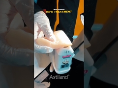 testemunhar o poder de elevação não invasivo do HIFU