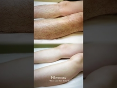 Apresento a mais recente máquina de depilação a laser de fibra, a Astiland Fibermax!