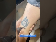laser de picossegundos para remoção de tatuagens