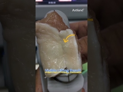 vamos verificar o efeito de lifting instantâneo do HIFU