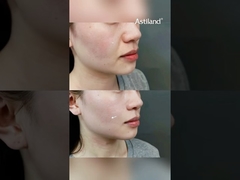 Já Experimentou RF+ HIFU para Reafirmar a Pele? #AntiIdade #LiftingFacial #clínicadebeleza #tratamentofacial